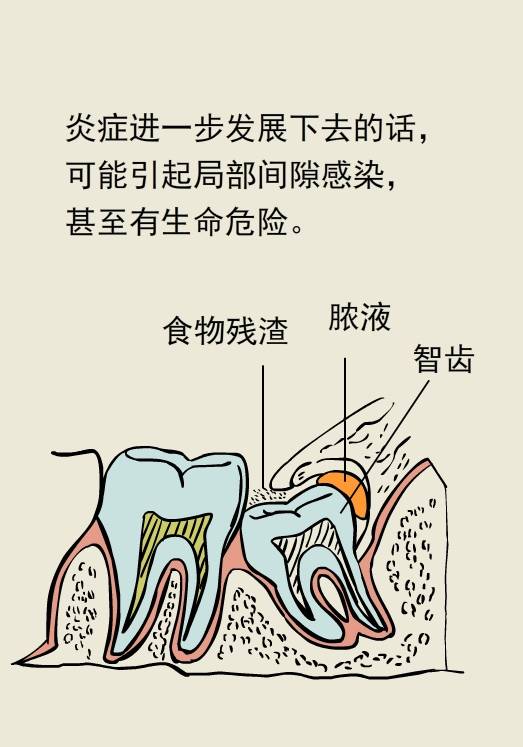 智齒到底要不要拔掉?