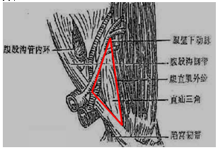 腹股沟直疝三角图片