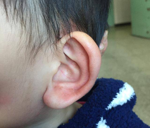 儿童大耳巴的症状图片图片