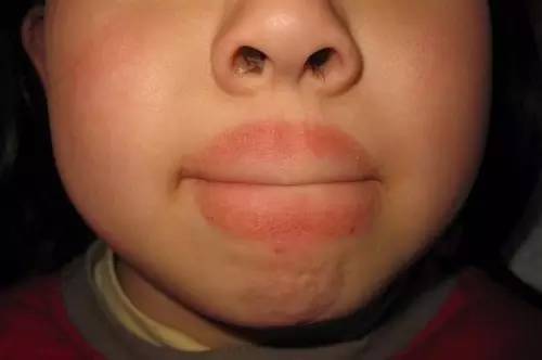 这个11岁男孩把嘴唇舔成香肠嘴!