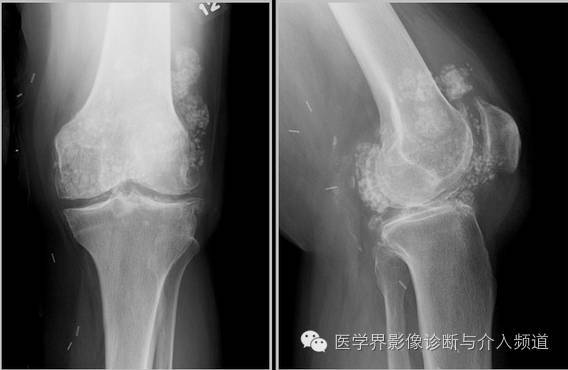 常見於膝蓋,恥骨聯合,臀部,尺骨三角纖維軟骨複合體,肩關節.