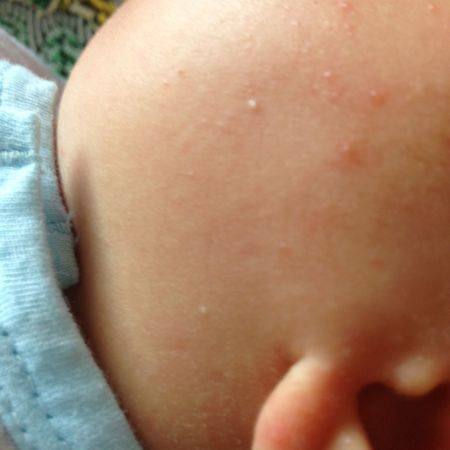 新生儿粟粒疹怎么治疗图片