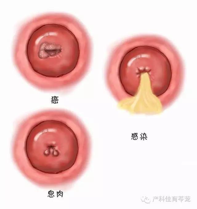 宫颈接触性出血图片图片
