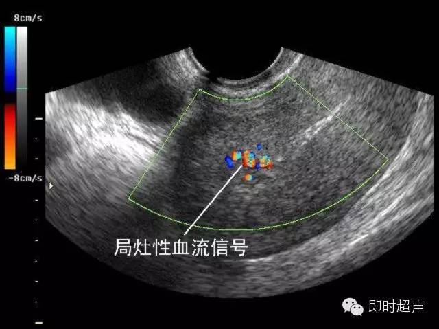 少許絨毛組織殘留彩超表現