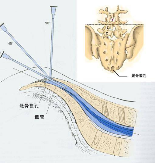 骶管位置图图片