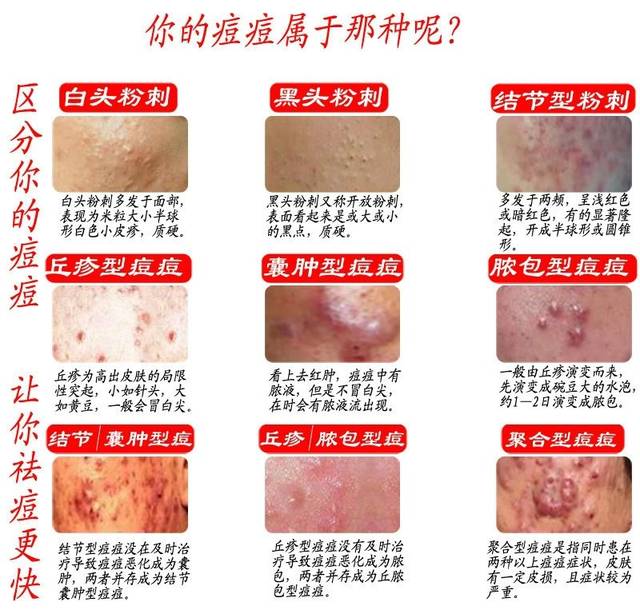 痘痘的分类图解图片