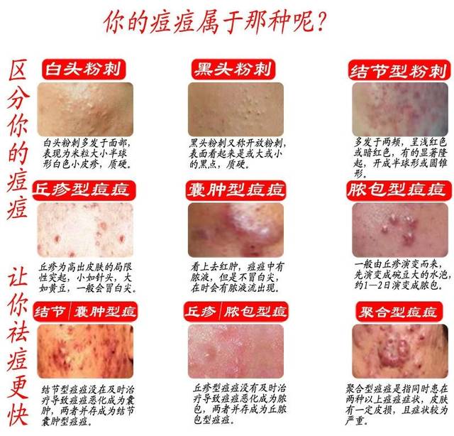 痘痘种类(分轻中重度 看看你自己是属于哪种痘痘?