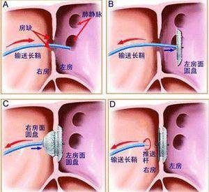 心脏支架,心脏瓣膜是什么样子?