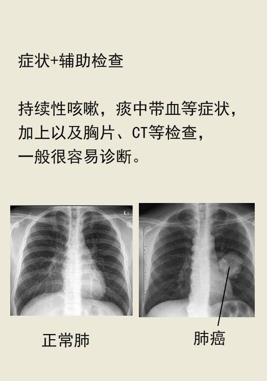 肺癌的片子图片图片