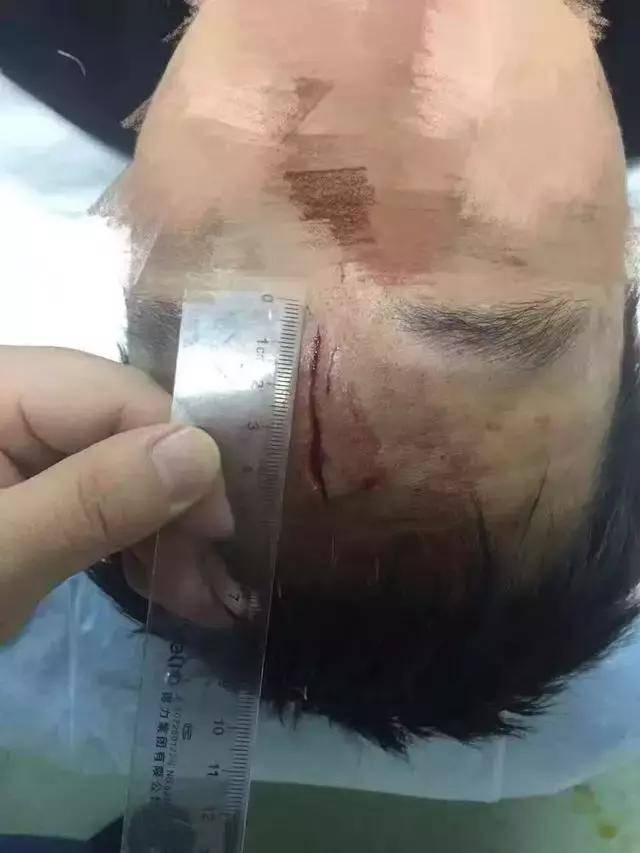 月    日夜里,南京军区南京总医院一名急诊科医生被打伤,额头伤口长
