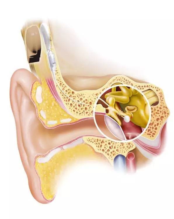 人工中耳