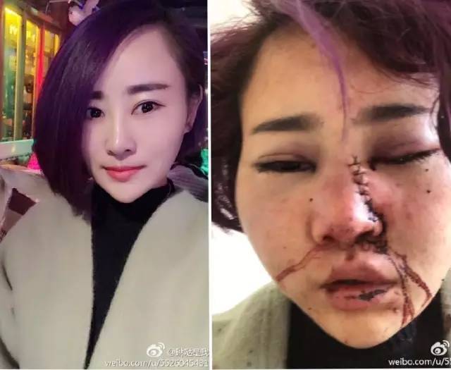 她和朋友在丽江一烧烤店 遭遇抢劫 并 被打致毁容 脸上缝多针