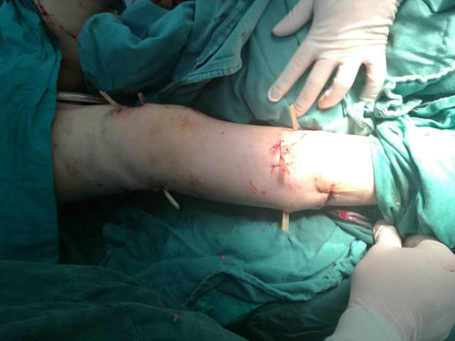 手术后,全身多处犬咬伤虽然经过了缝合, 但创面的狰狞程度还是让人
