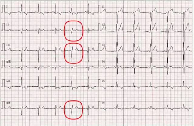 二尖瓣后叶脱垂并重度关闭不全入院,ecg示异常q波及st段压低;心电图v1
