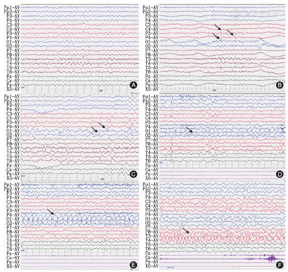 脑电图尖波和棘波图片
