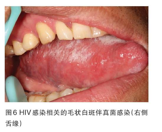 艾滋病口腔毛状白斑图片
