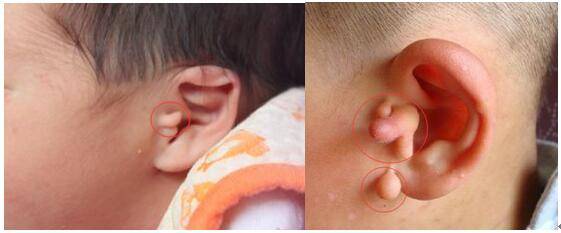 新生儿耳朵上有小肉丁图片