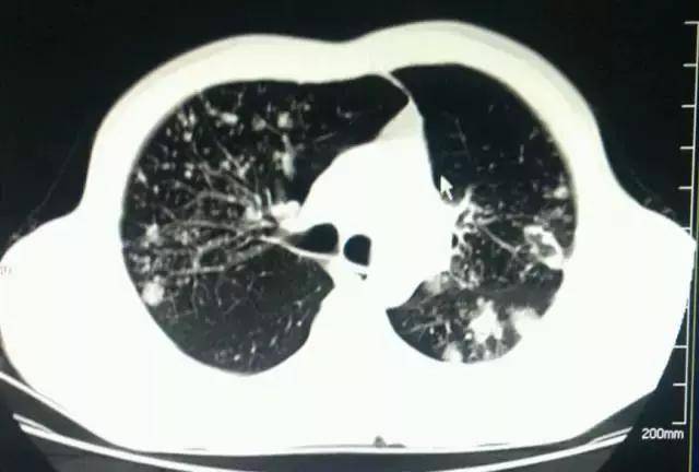 继发型肺结核图片