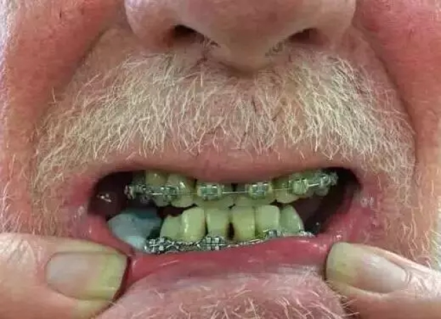 老人不能矫正牙齿
