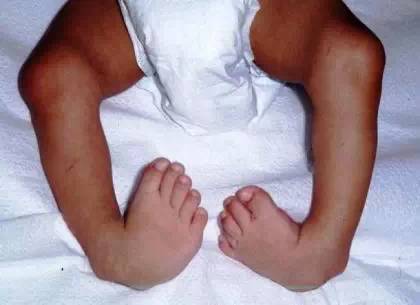 半椎体畸形图片宝宝图片