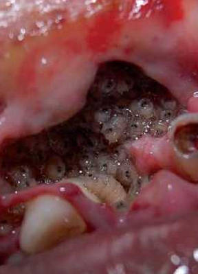 牙齿里面的蛀虫图片图片