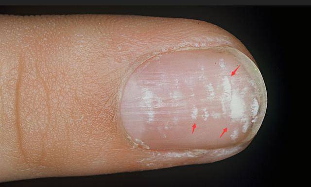 指甲蛔虫斑图片图片