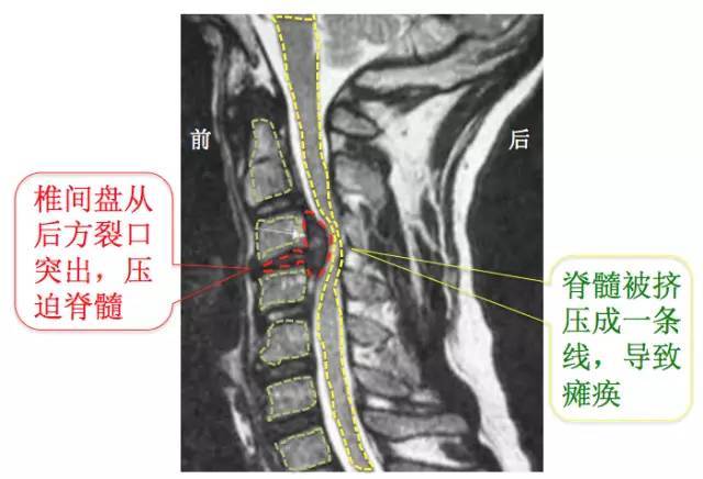 颈椎病mri图片讲解图片