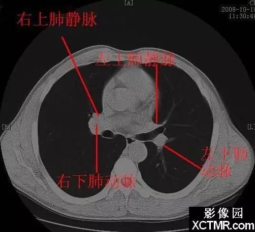 胸壁肌肉解剖ct横断面图片