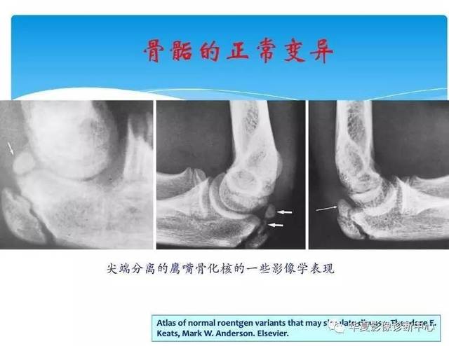 儿童肘关节骨化中心生理及变异