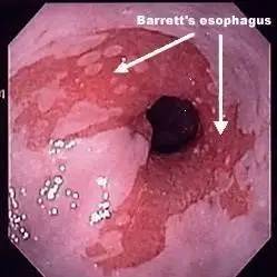 消化科普丨胃镜报告里的Barrett食管是什么