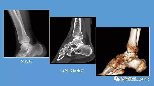 核磁共振跟腱断裂图图片