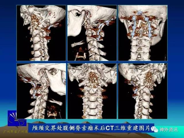 病例分享 王国良教授:颅颈交界处腹侧脊索瘤的手术治疗策略