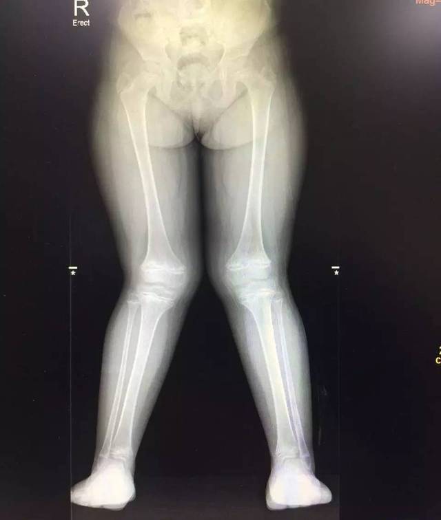 x型腿还关节互相碰撞可能是膝外翻在作怪