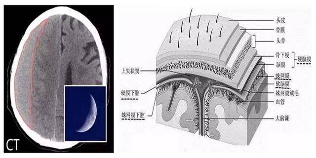 硬脑膜外血肿解剖图片