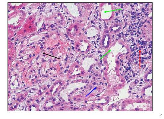 肾内病理图解:小管间质性肾炎