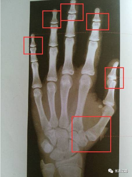骨骼闭合片子手骨对比图片