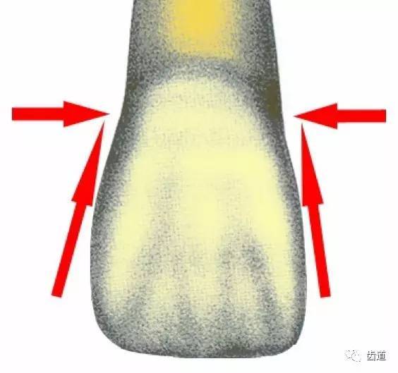 上颌中切牙的轴面图图片