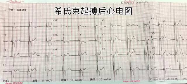 希氏束起搏,真正的生理性起搏|哈特瑞姆心律工坊