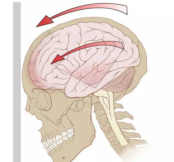 轻型闭合性颅脑损伤,主要就是老百姓常说的脑震荡,该词源于拉丁语
