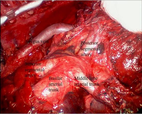 该图显示清除包括巨大肿瘤延伸到肺裂的1,800 cc肿瘤后骨骼化的右肺