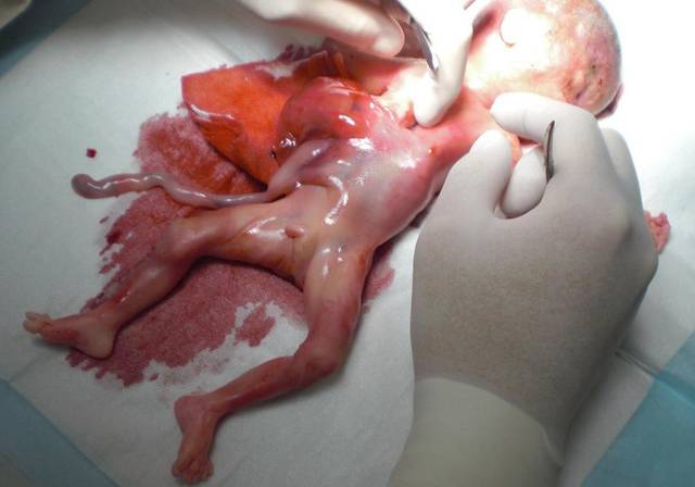 45天胎儿打下的图片图片