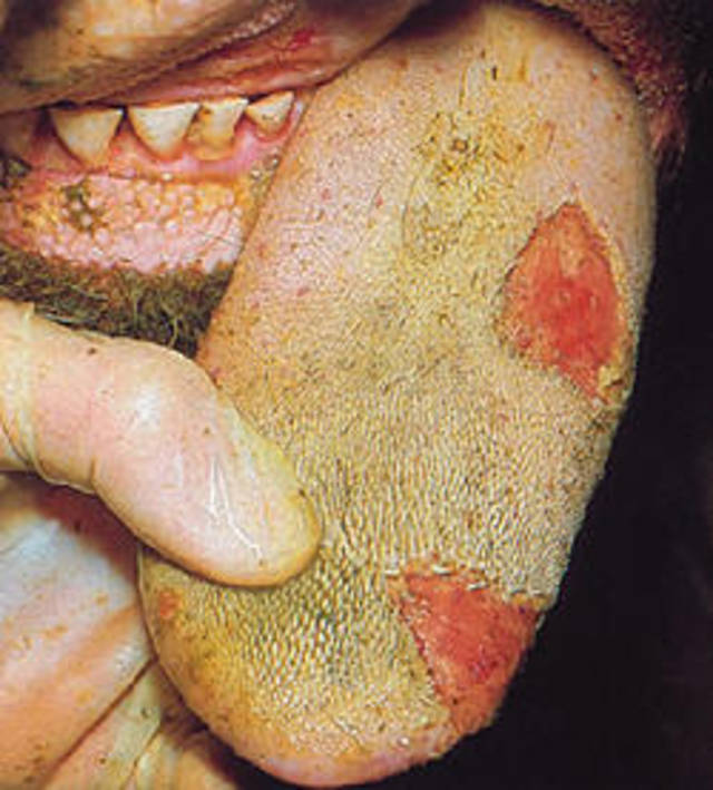 牛口蹄疫舌头症状图片图片