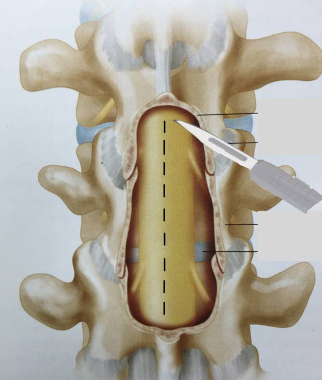 腰腿疼居然是因椎管內長腫瘤?手術全程是這樣的.