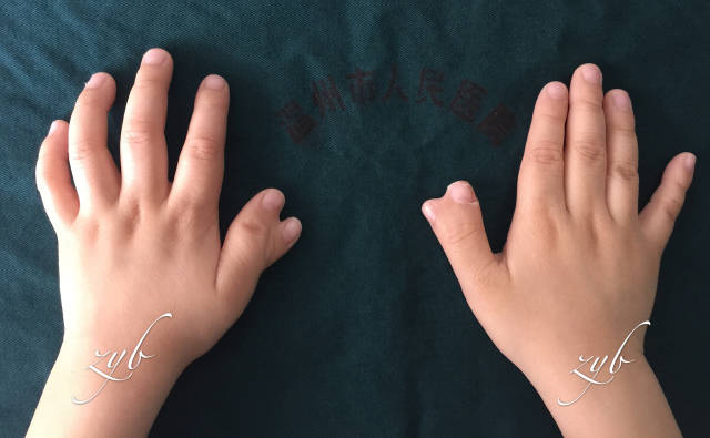 温州五岁小男孩双手演绎六指琴魔医生妙手让其伸手见五指