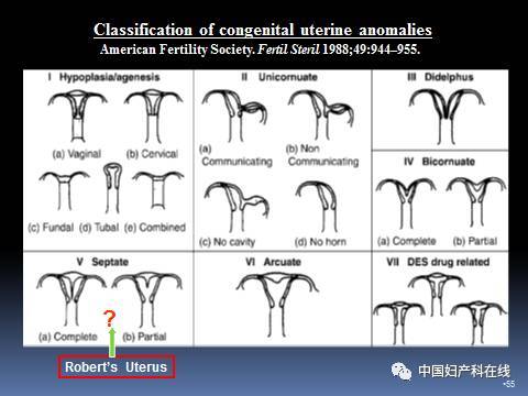 常见的子宫畸形图片图片