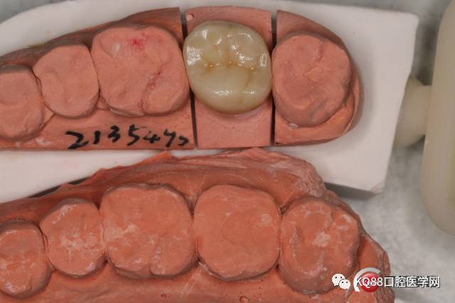 后牙氧化锆粘结修复