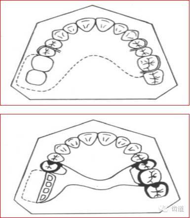肯氏三类义齿设计图片图片
