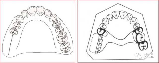 义齿形态讲解图解图片