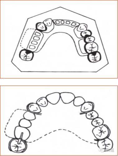 活动义齿设计单画法图片