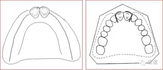 肯氏三类义齿设计图片图片
